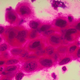 A close-up look of cervical cancer. Photo: American Cancer Society/Getty Images